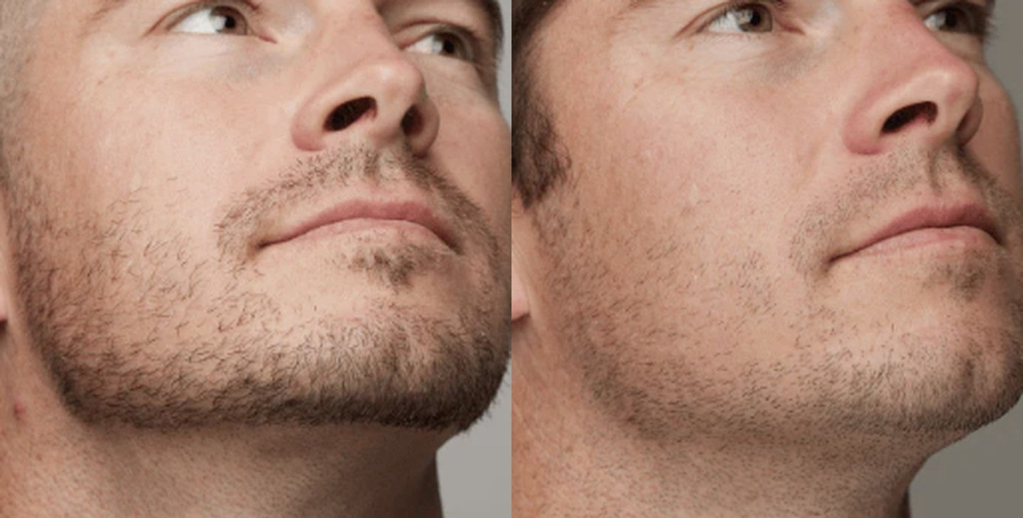 Beard line: before on the left, after on the right