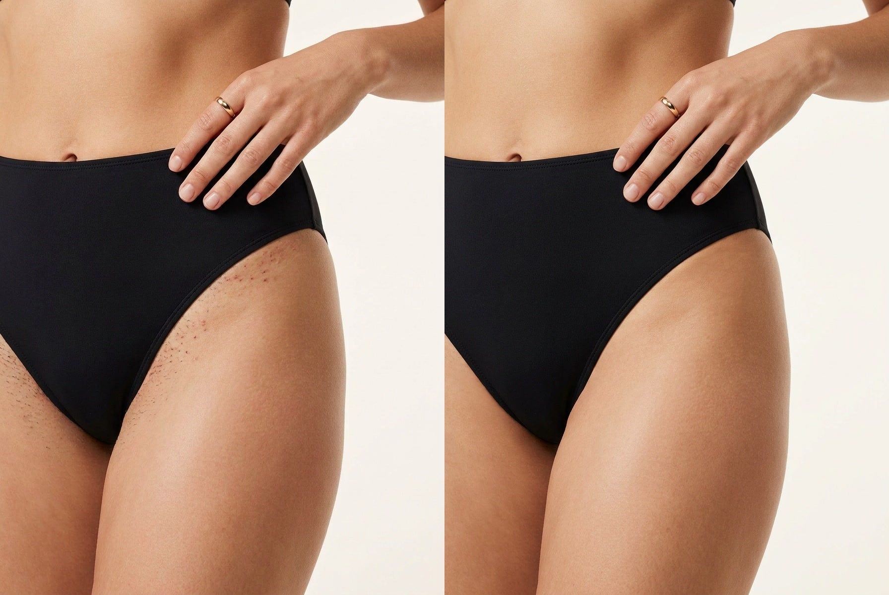 Bikini line: before on the left, after on the right